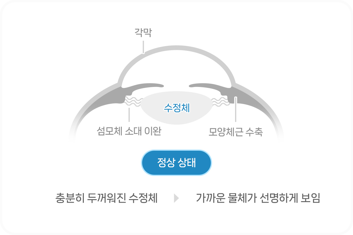 노안 백내장 차이점 _ 노안이란?