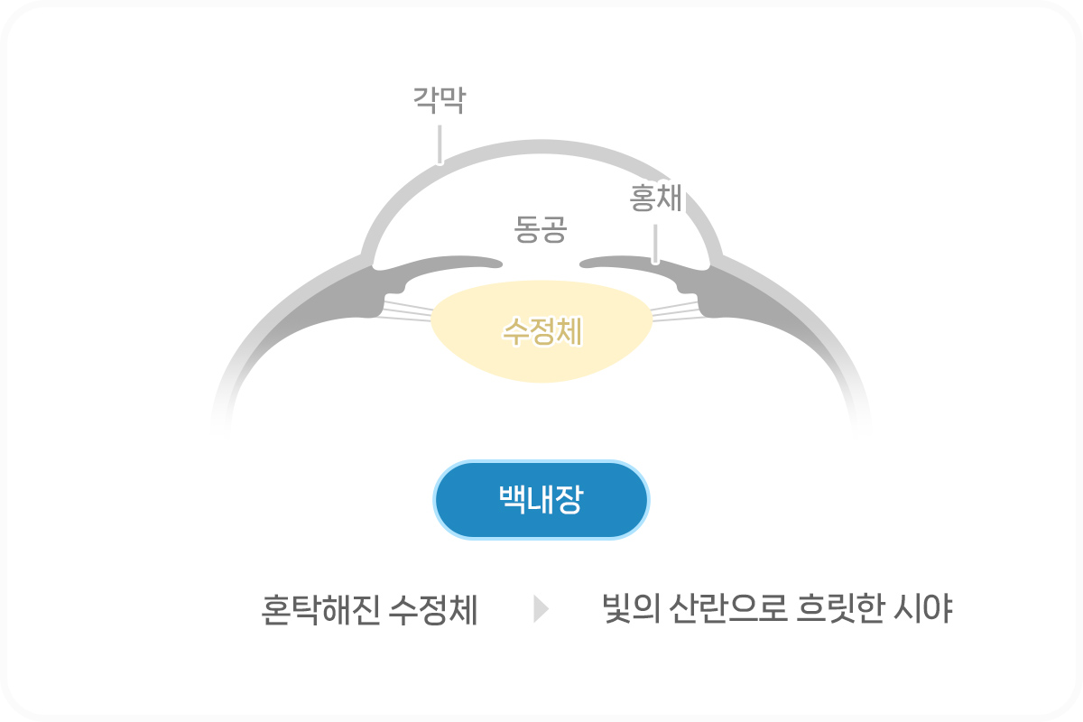 노안 백내장 차이점_ 백내장이란?
