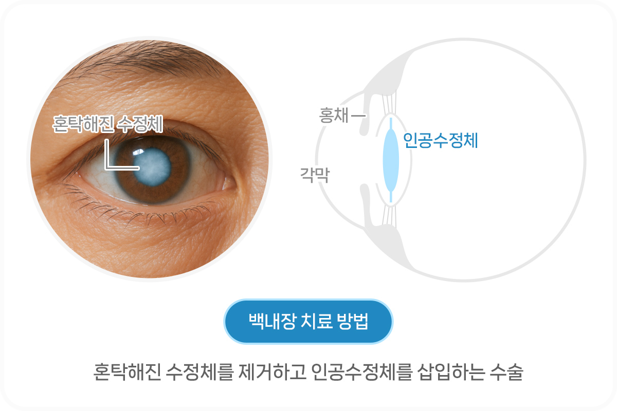 노안 백내장 차이점_ 백내장 치료 방법